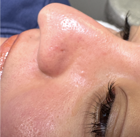 After Nose Cleaning